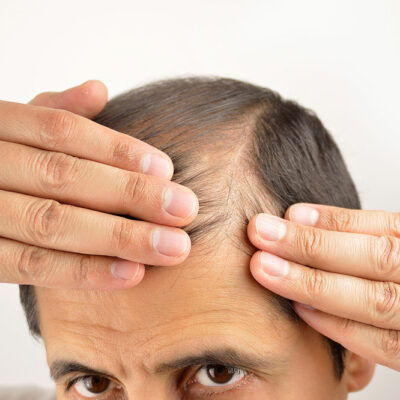 How to Prevent Hair Loss in Men and Women