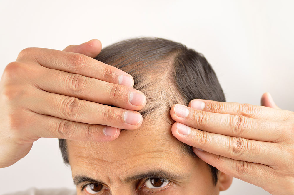 How to Prevent Hair Loss in Men and Women