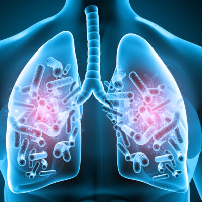 What Is Mac Lung Disease and How is it Contracted?